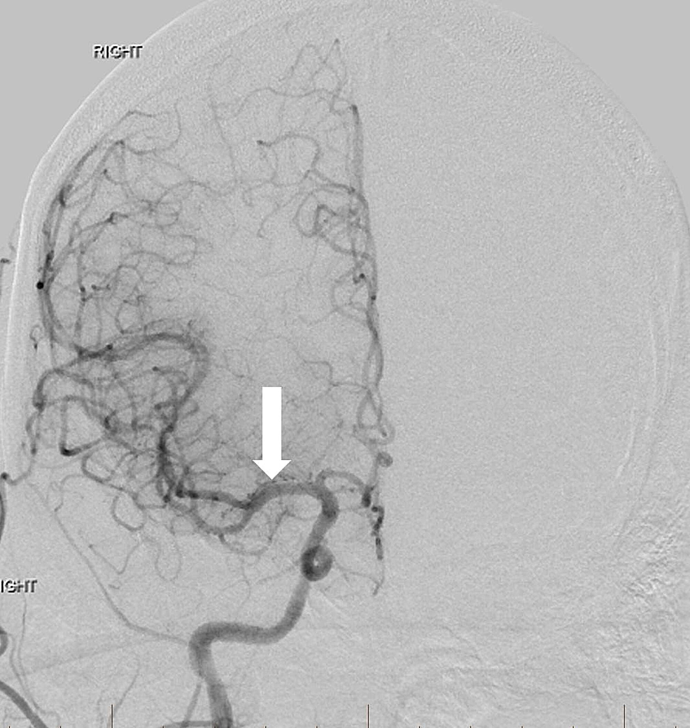 After-angioplasty-of-the-extracranial-right-internal-carotid-artery-origin-and-intracranial-thrombectomy,-frontal-view-right-common-carotid-artery-angiogram-reveals-normal-intracranial-arterial-flow-with-excellent-recanalization-(arrow).