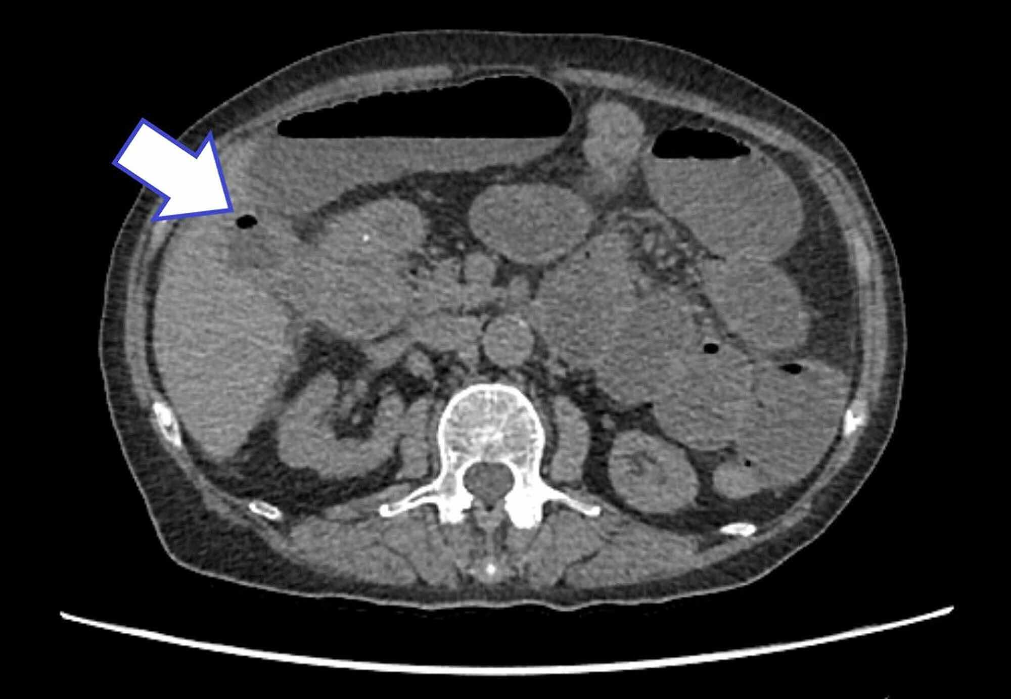 Cureus Gallstone Ileus Uncommon Presentation Followed By Less Common