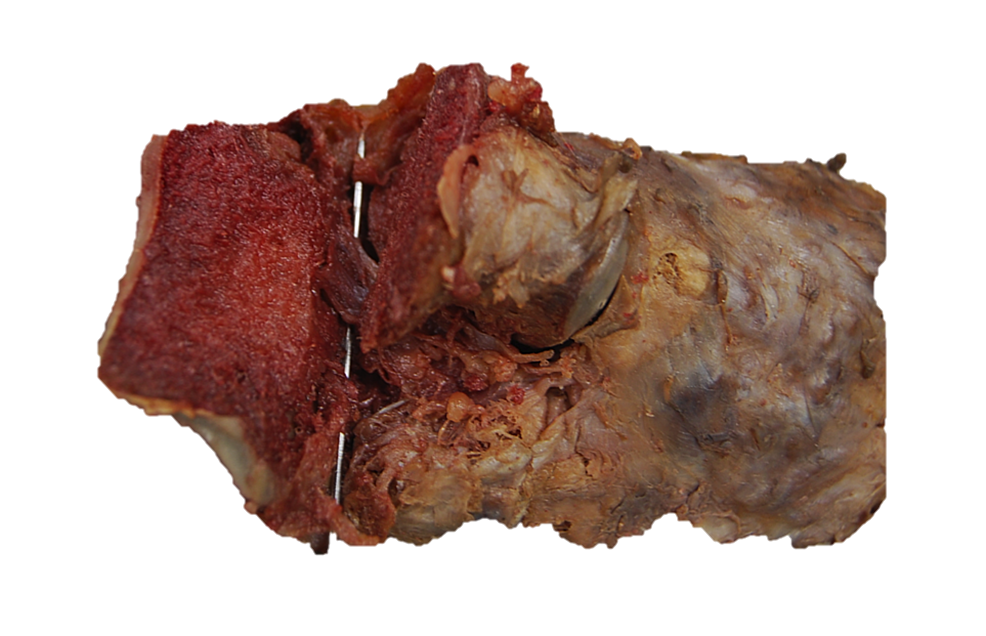 Figure-showing-the-dissection-of-the-talocalcaneal-interosseous-ligament-(over-pointer)-following-axial-section-through-the-talus