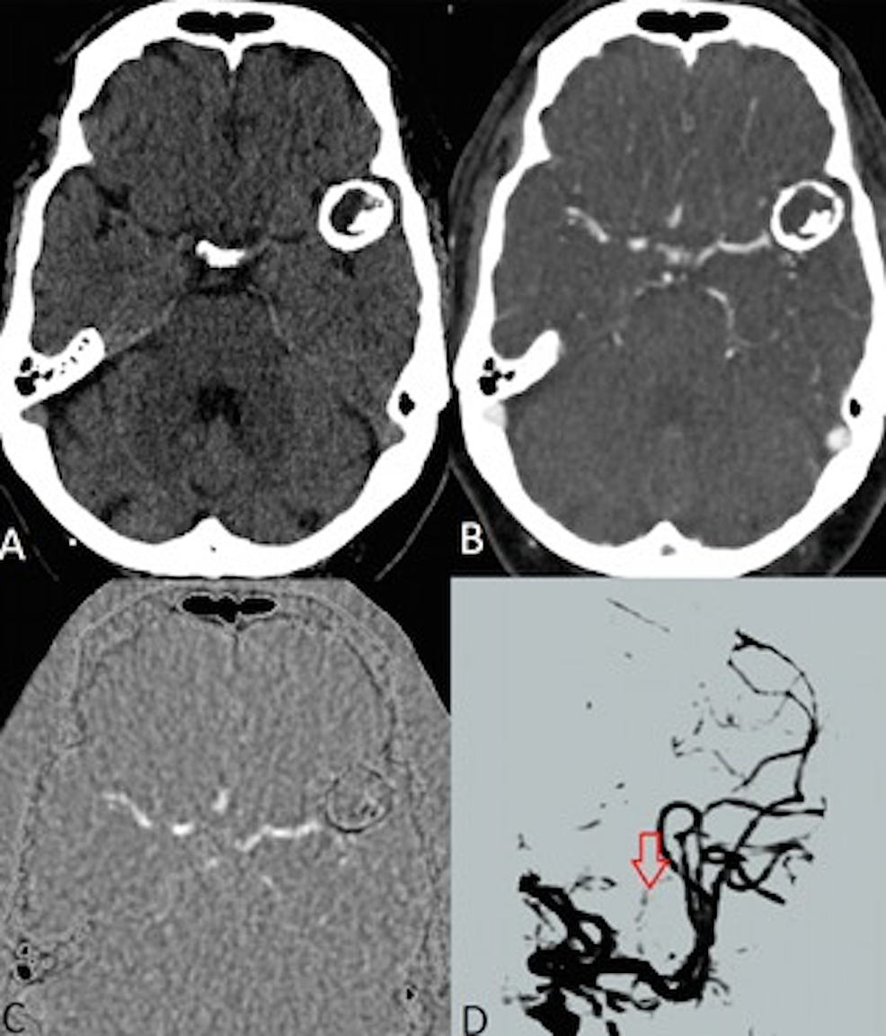 Images-from-the-4D-digital-subtraction-CT-angiogram.-