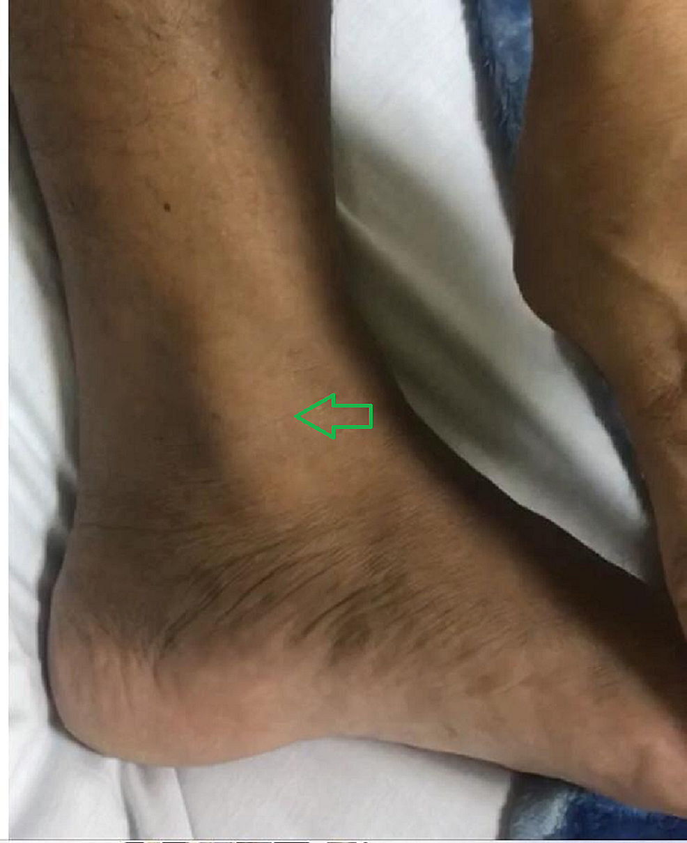 Cureus Traumatic Dislocation Of Tibialis Posterior Tendon A Case The