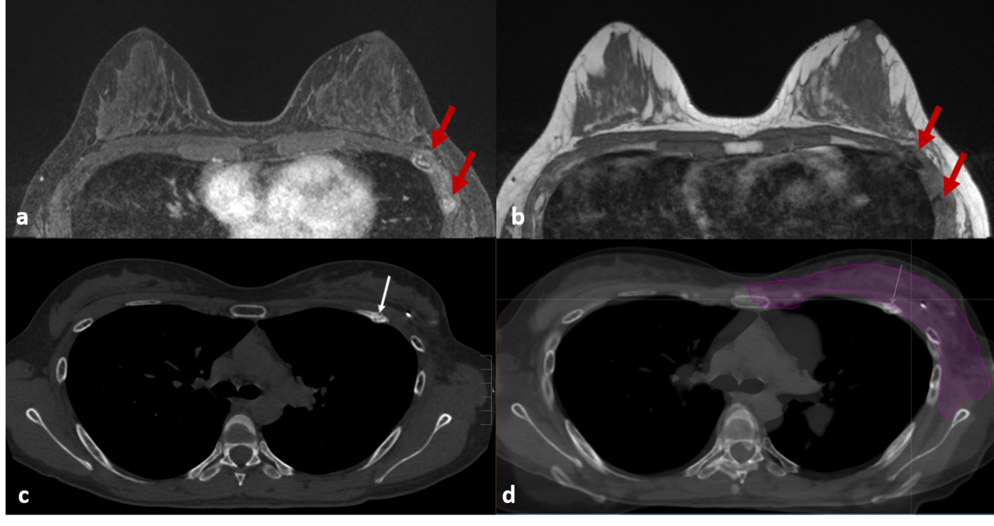 Cureus Radiation Induced Rib Fractures On Magnetic Resonance Imaging