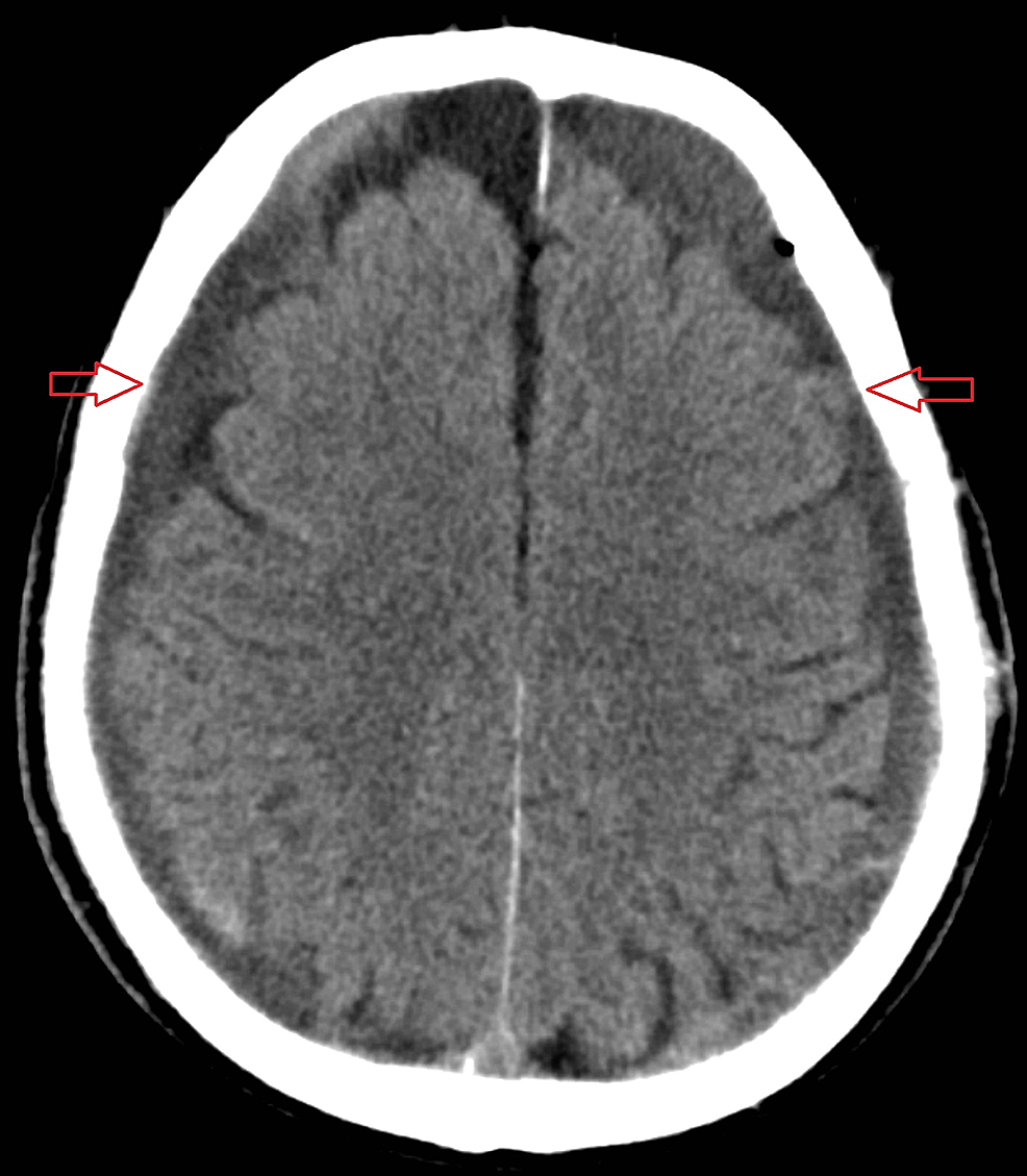 Axial-non-contrast-computed-tomography-scan-of-the-brain