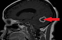Article_box_a187aa904a6311e7b8897b1d2c9777c4-tuberculoma---figure-1---900-pixil-scale---updated-with-arrow