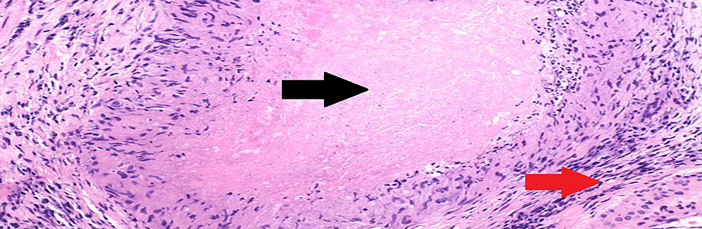 Necrotizing-granulomas-on-histopathology