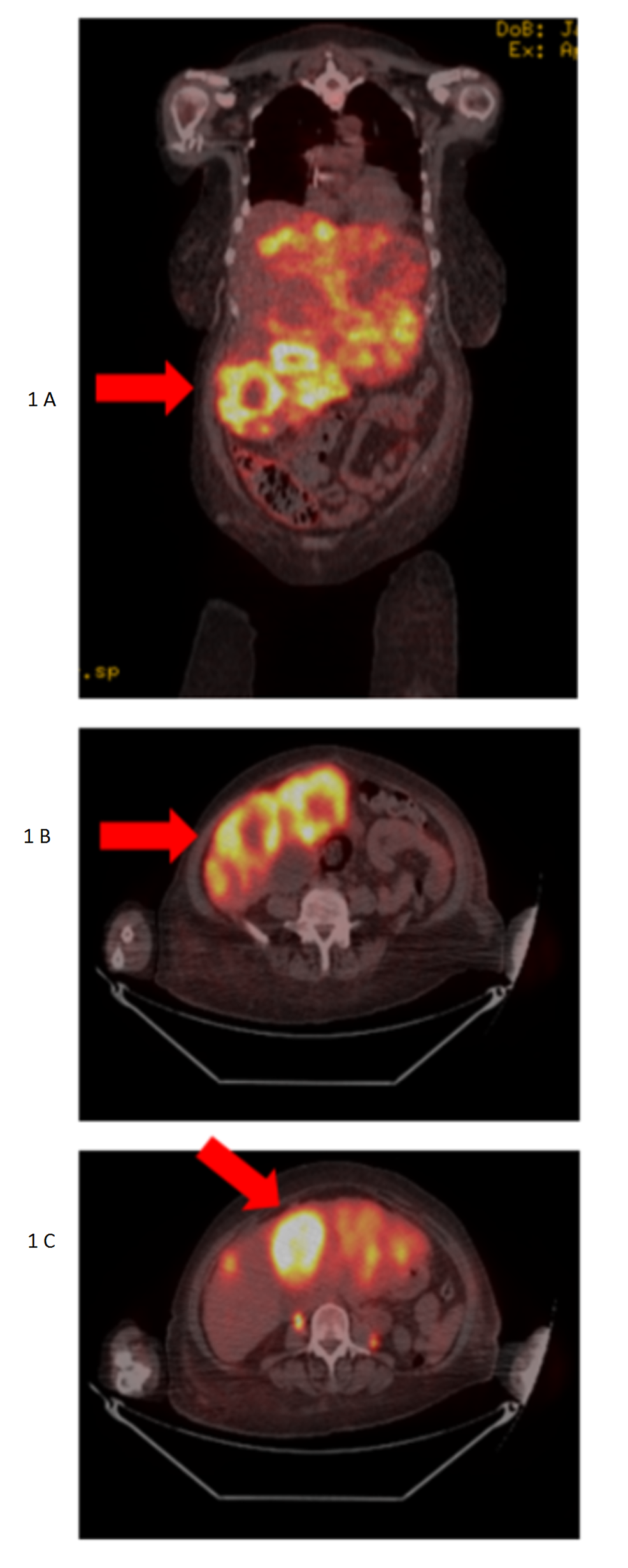Lung cancer surgical treatment to dispose of lobe opportunity remedy for breast cancer uk