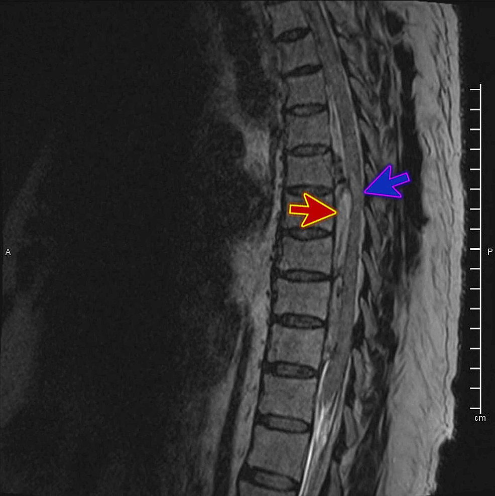 Cureus Acute Spinal Extradural Hematoma And Cord Compression Case Report And A Literature Review