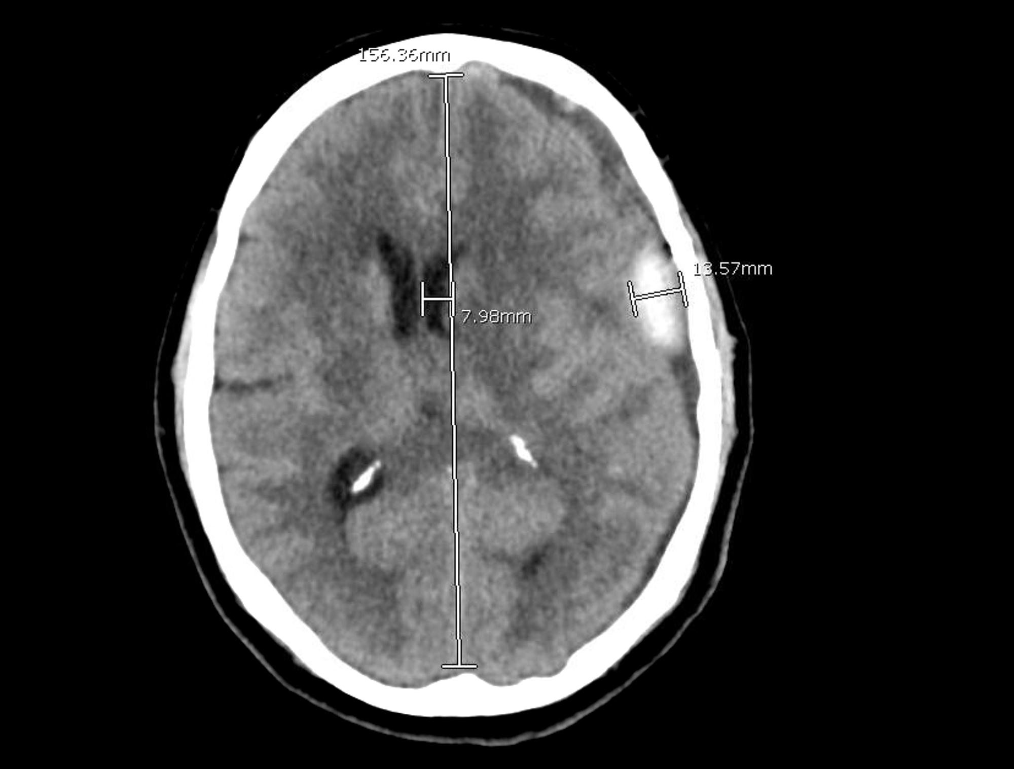 Cureus Minimally Invasive Approach To Subdural Hematoma Treatment SexiezPicz Web Porn