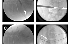 Article_box_8a2c95d04f8211e7b9e4f9984809265f-scoliosis_fluoro