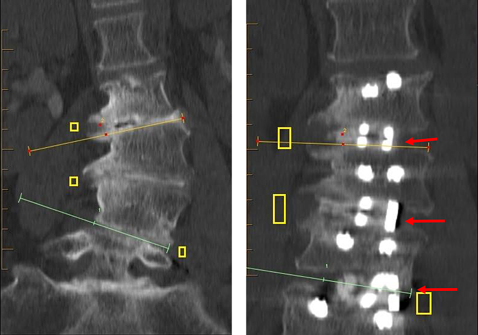 Deformity-correction-can-be-achieved-through-careful-cage-placement.