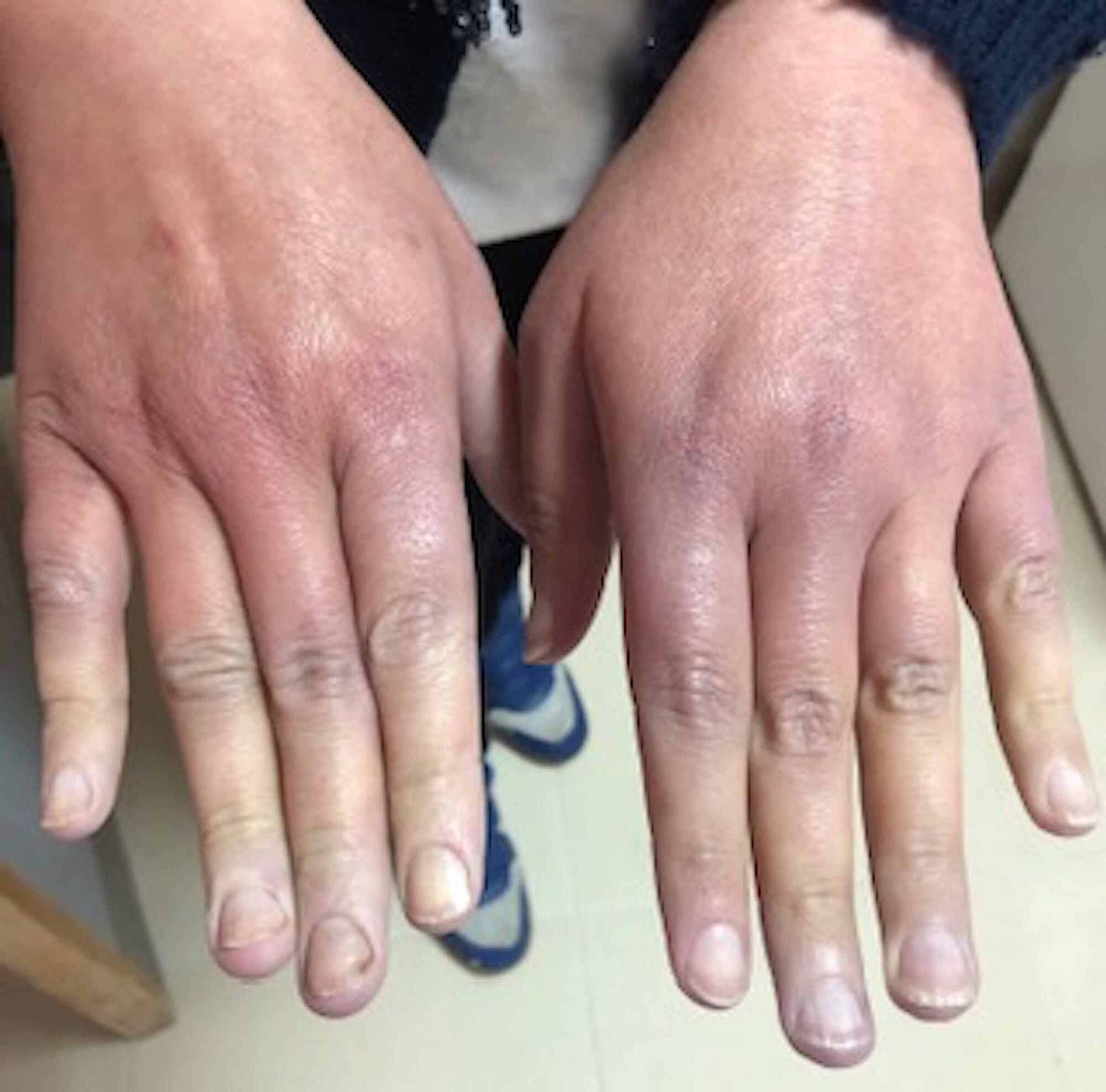 Cureus Raynaud S Phenomenon Beware Of Cancers