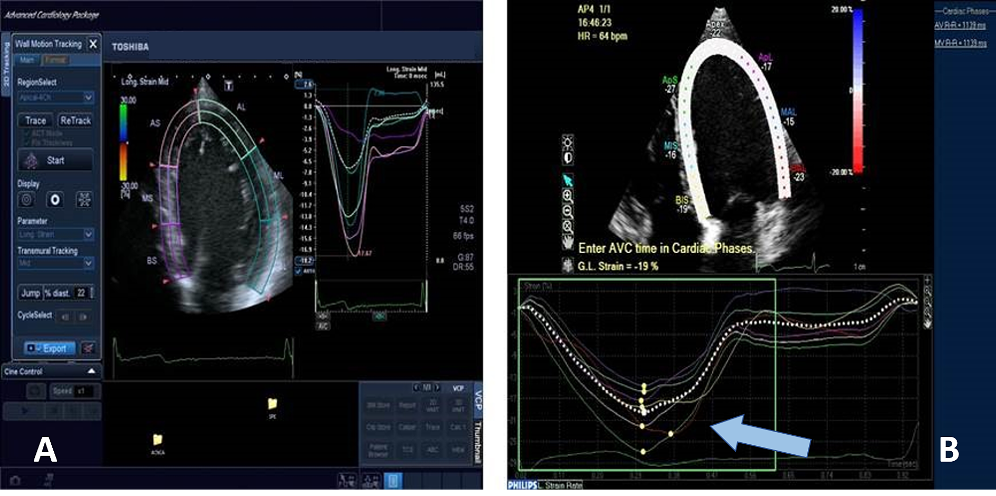 Cureus | Role Of Speckle Tracking Echocardiography In Dilated ...