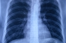 Article_box_cce1d3604f7111e7b0f6cd6d9cf81833-chestxray