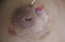 Article_box_40f517c04f7d11e78f66f9475f8ab9ea-rt-breast