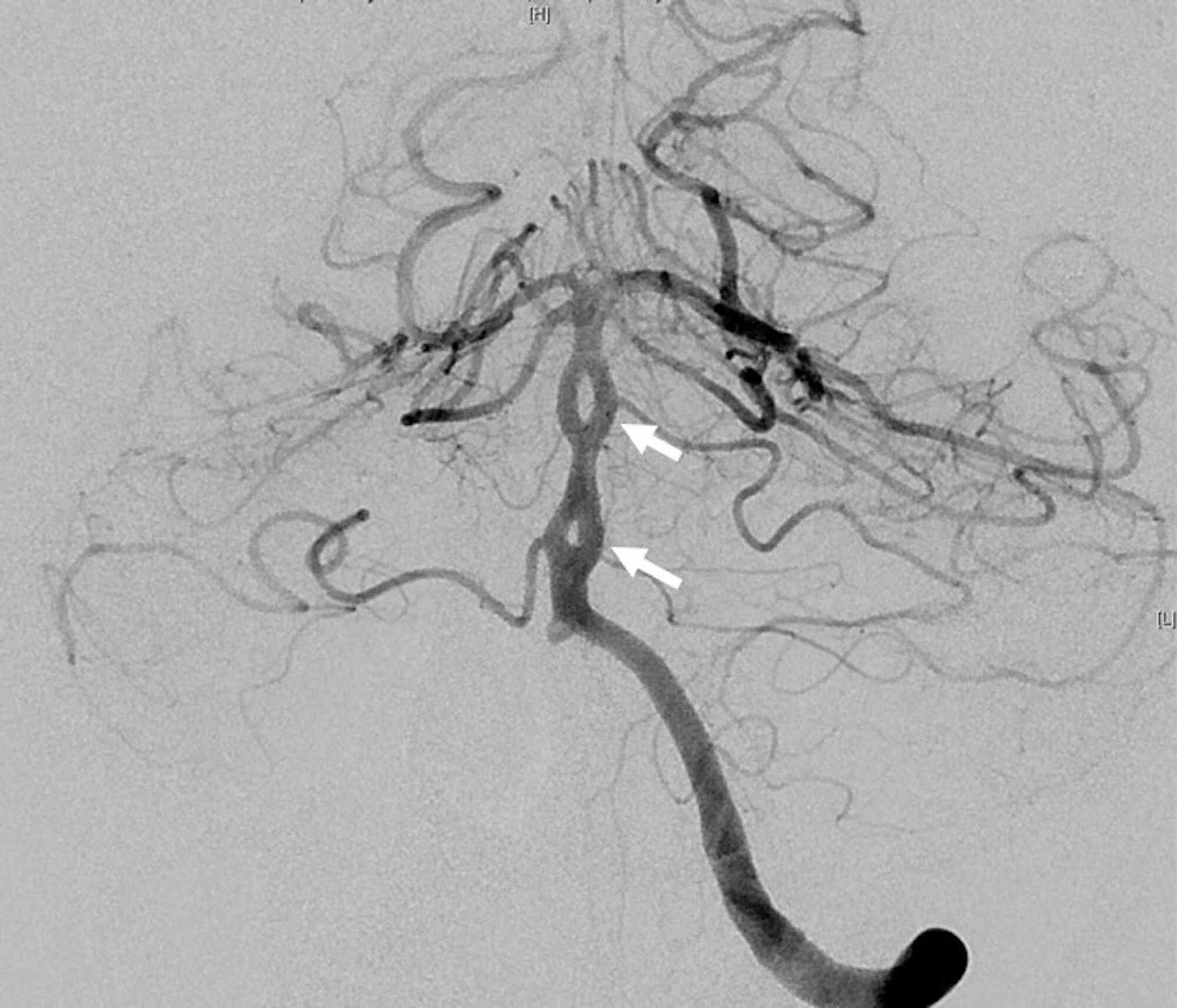 Cureus Multiple Anterior And Posterior Circulation Intracranial