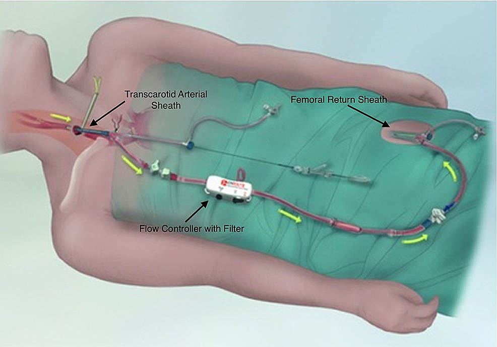 Anesthetic Considerations For Transcarotid Artery Revascularization