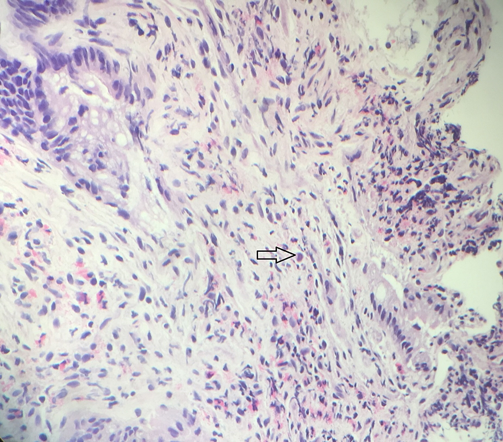 Haemotoxylin-and-eosin-(H&E)-stain:-slide-from-colon-and-sigmoid-resection-specimen
