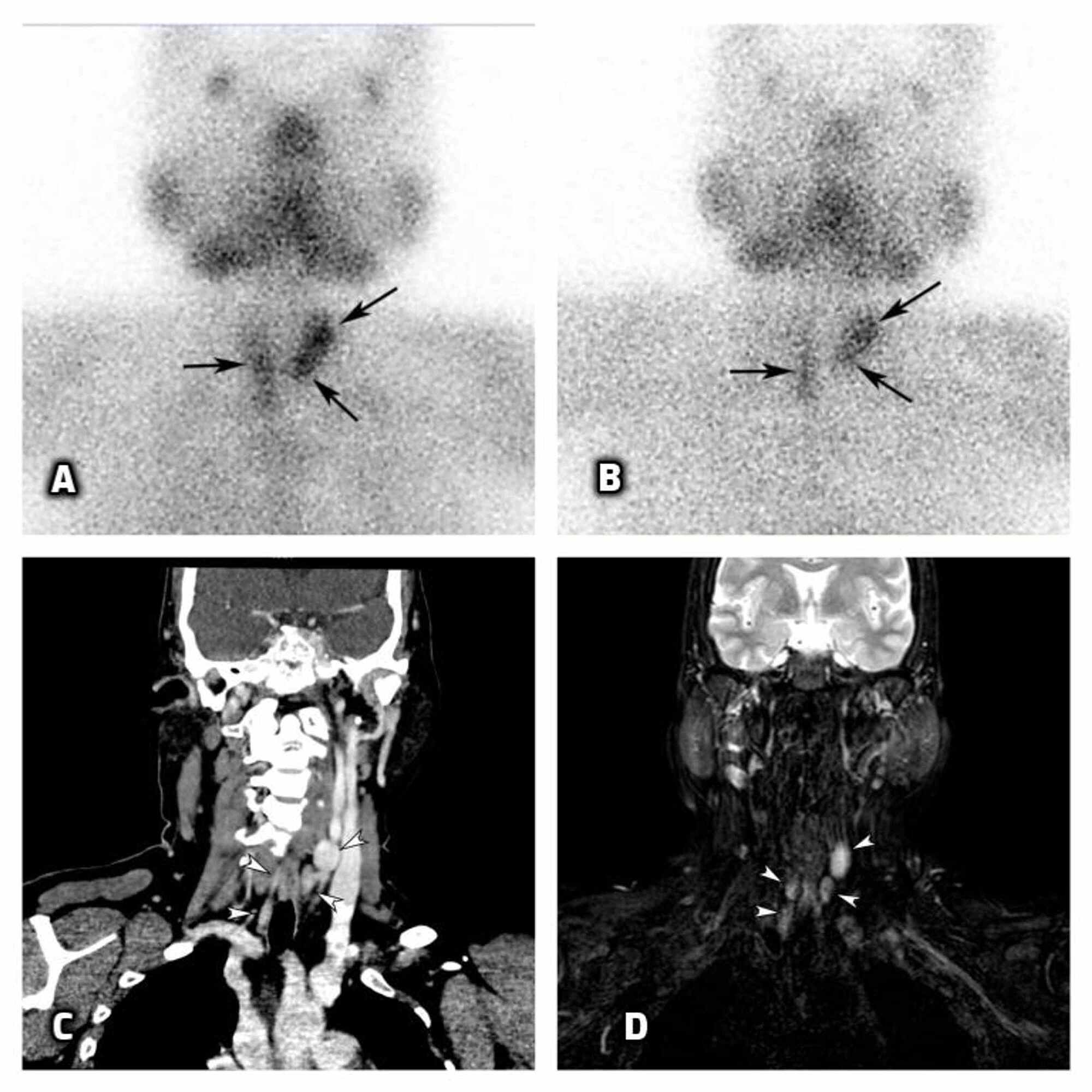 Cureus Multiple Endocrine Neoplasia Type Syndrome A Case Report