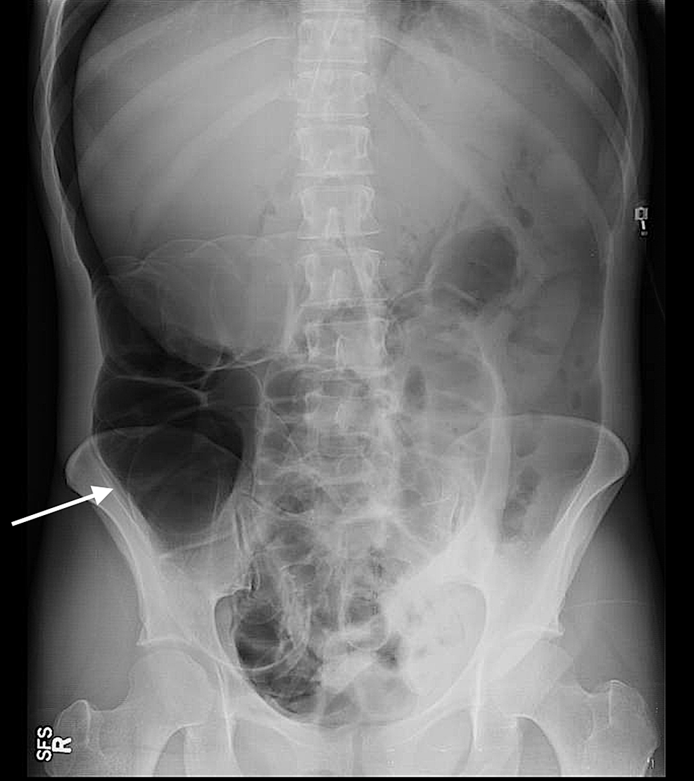 X-Ray-abdomen
