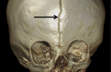 Article_box_9de15bf055f511e7ad2d69f480c58d4b-fig._1_anterior_fontanelle_wormian_bone