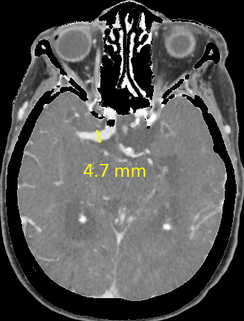 Dolichoectasia And Its Diagnostic Criteria A Case Report And