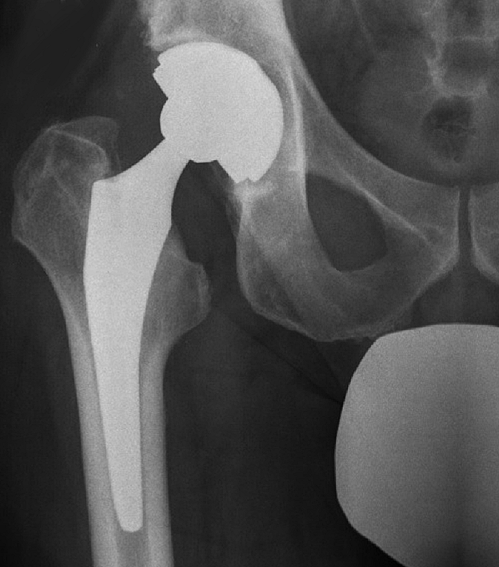 Cureus Surgical Management Of Iliopsoas Impingement With Combined