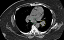 Sarcoidosis Presenting In Breast Imaging Clinic With Unilateral