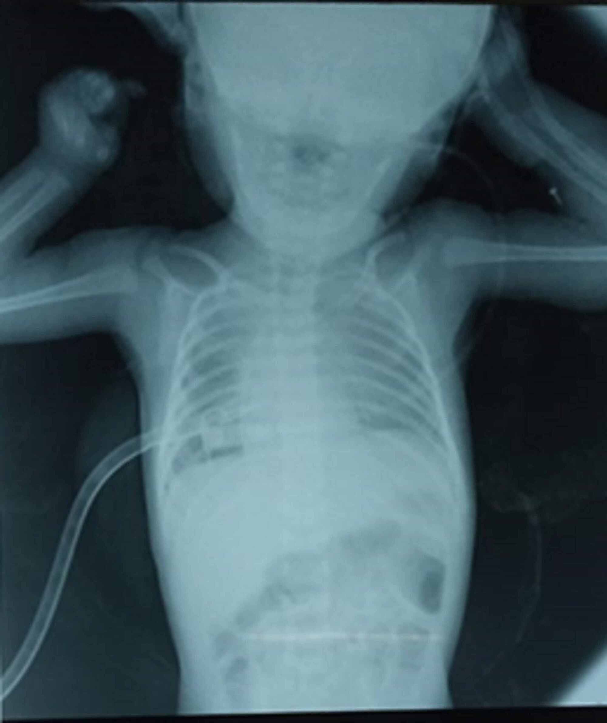 Cureus Management Of Spontaneous Chylothorax In A Neonate A Medical