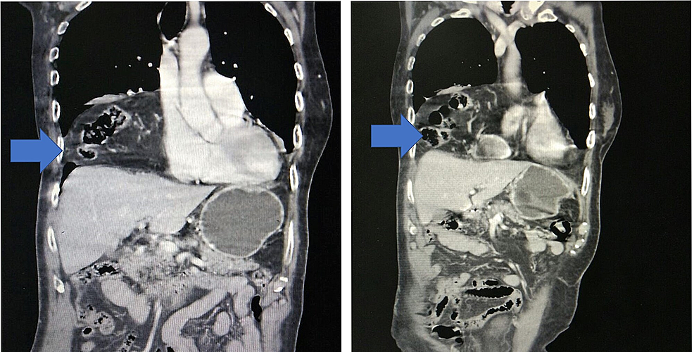 Cureus Hernia Of Morgagni In The Elderly A Case Report 8841