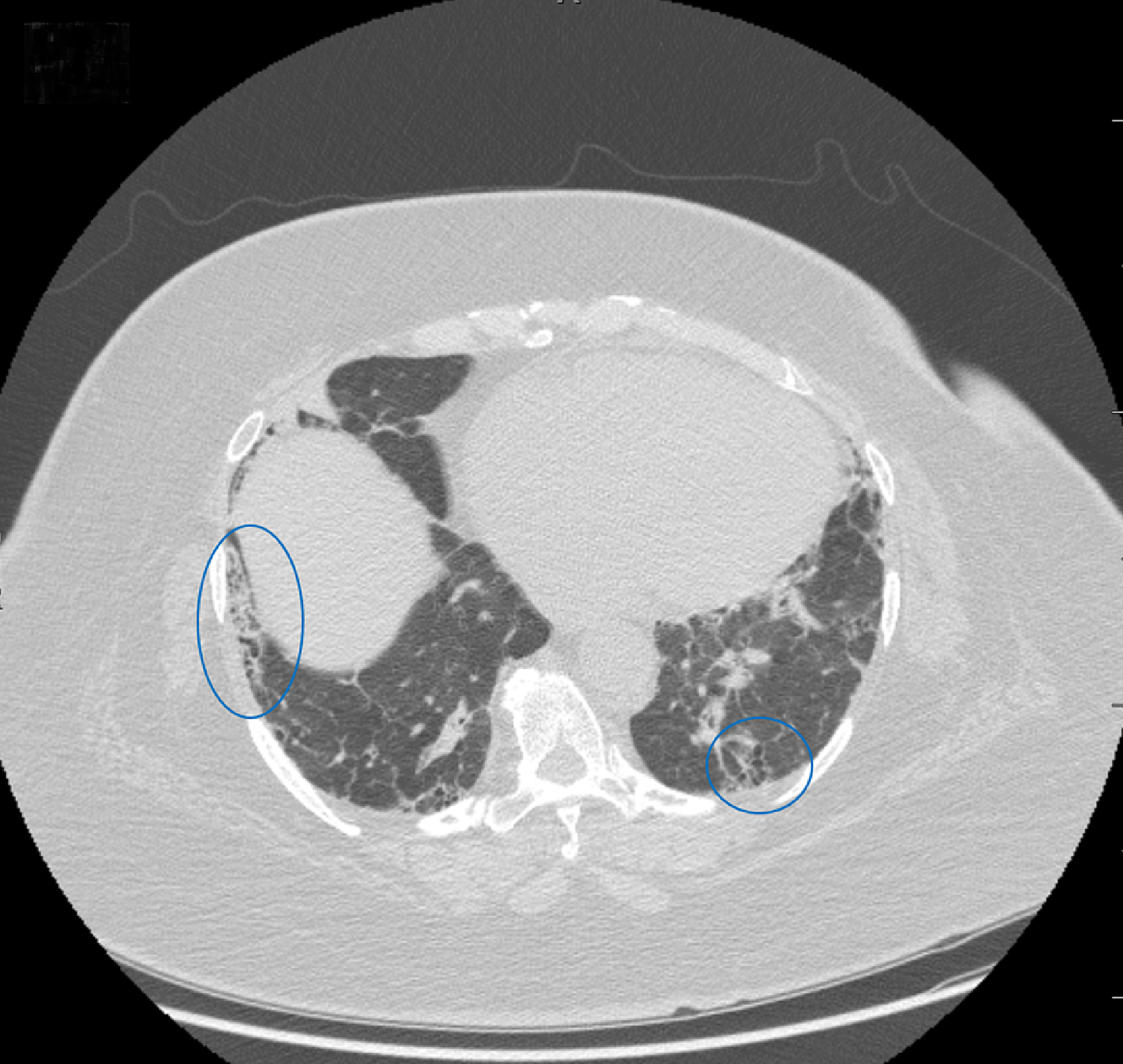 Sarcoidosis Presenting In Breast Imaging Clinic With Unilateral