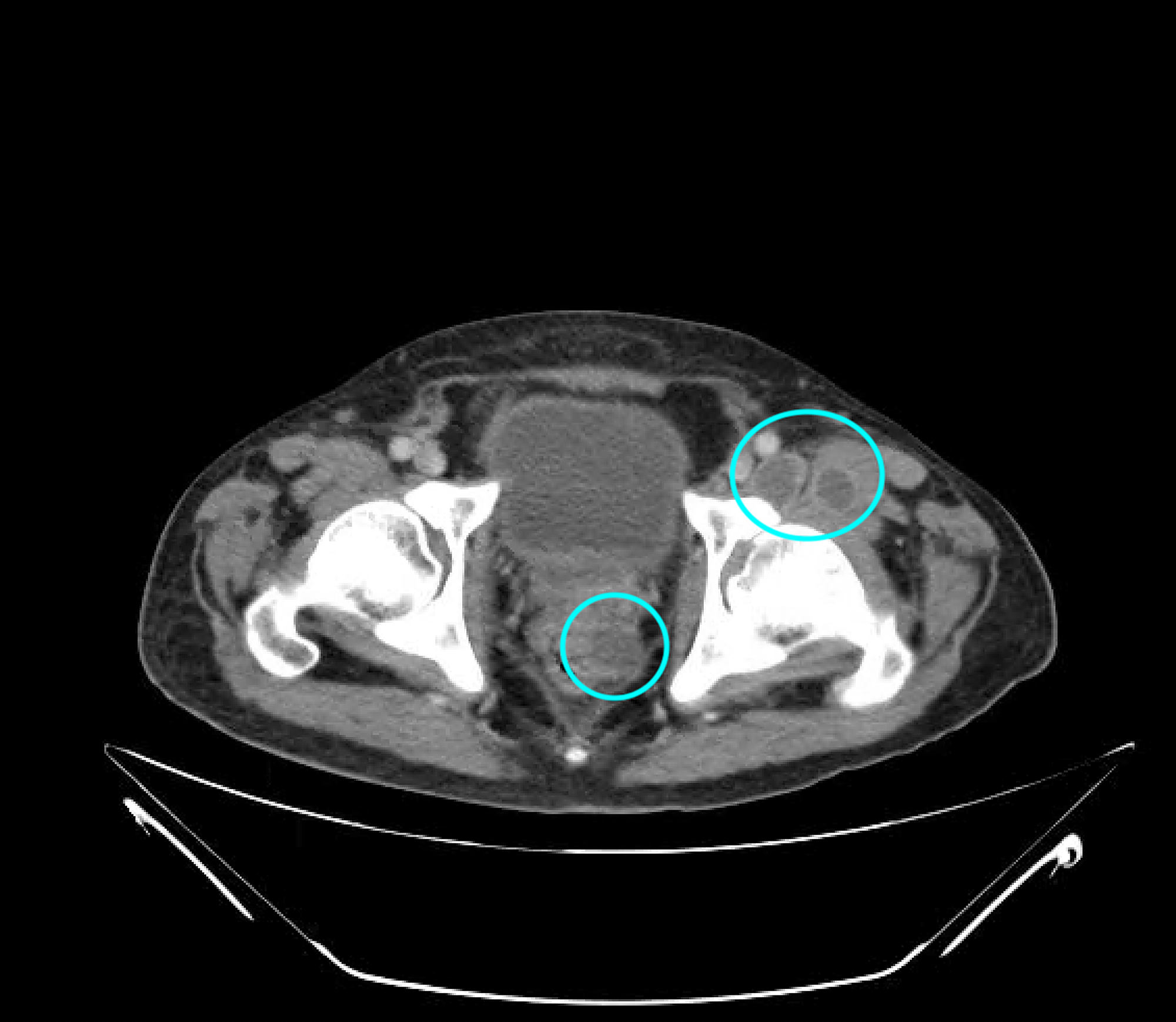 Cureus Septic Arthritis Caused By Perirectal Abscess Hot Sex Picture