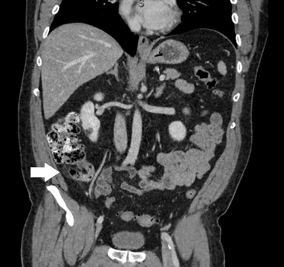 Cureus Appendiceal Goblet Cell Adenocarcinoma Case Report And Review Of The Literature