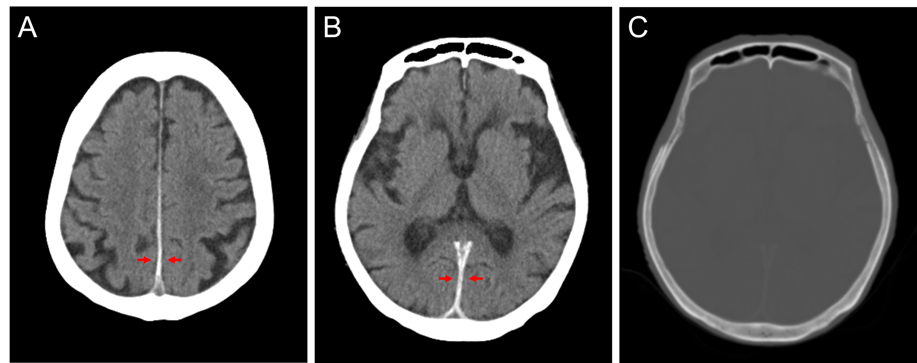 Cureus Symmetrical Interhemispheric Subdural Hematoma