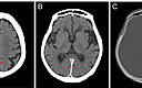 Symmetrical Interhemispheric Subdural Hematoma Cureus