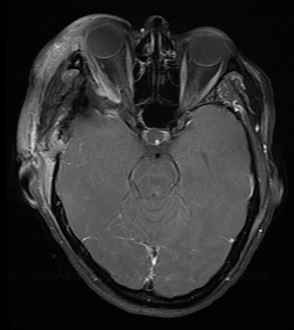 Cureus A Method for Combining Thin and Thick Malleable Titanium Mesh