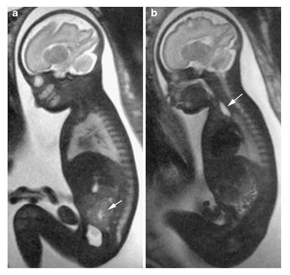 Cureus Fetal Resonance Imaging of Malformations Associated