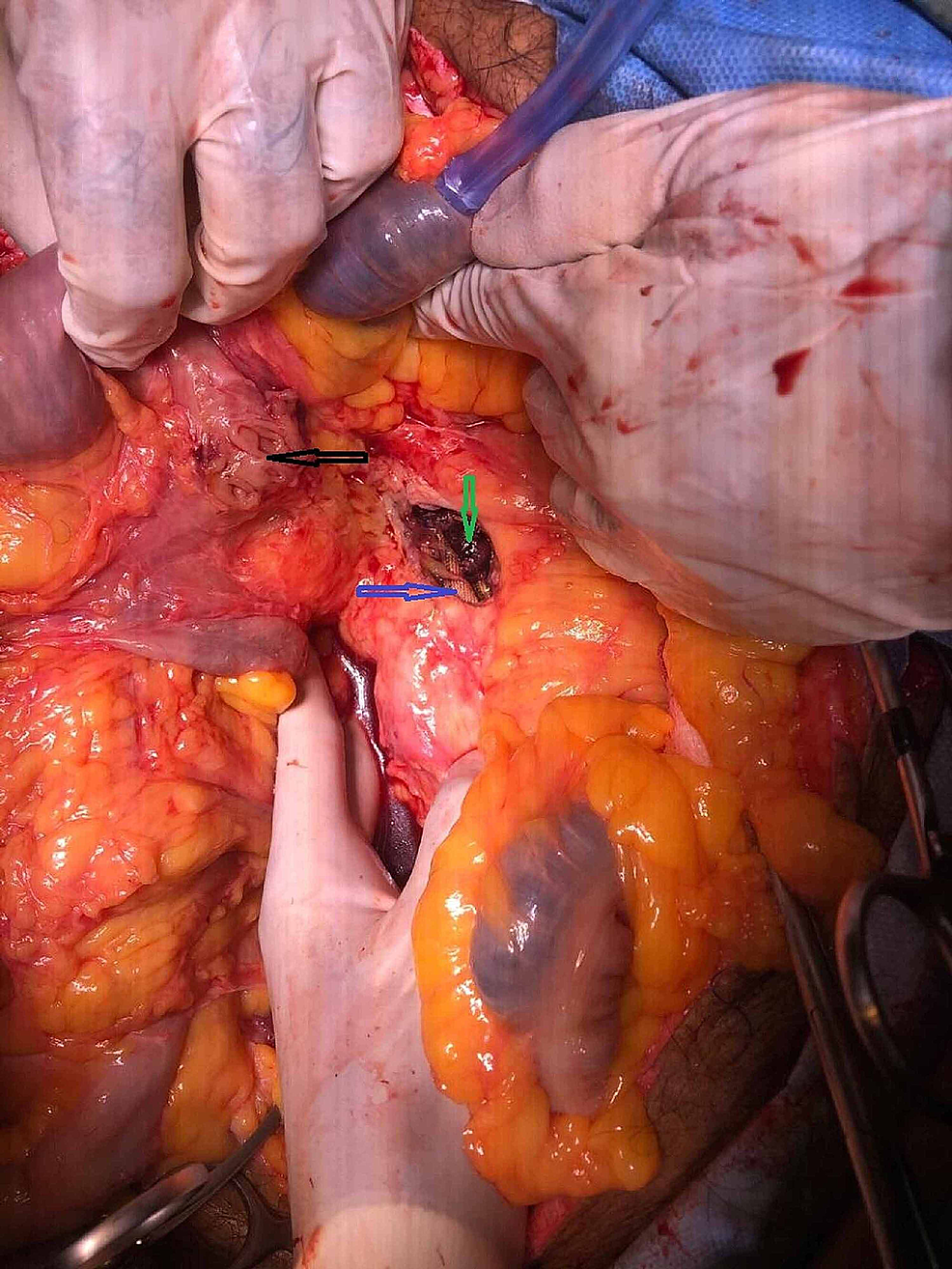 Cureus Local Repair Of A Secondary Aortoenteric Fistula In An