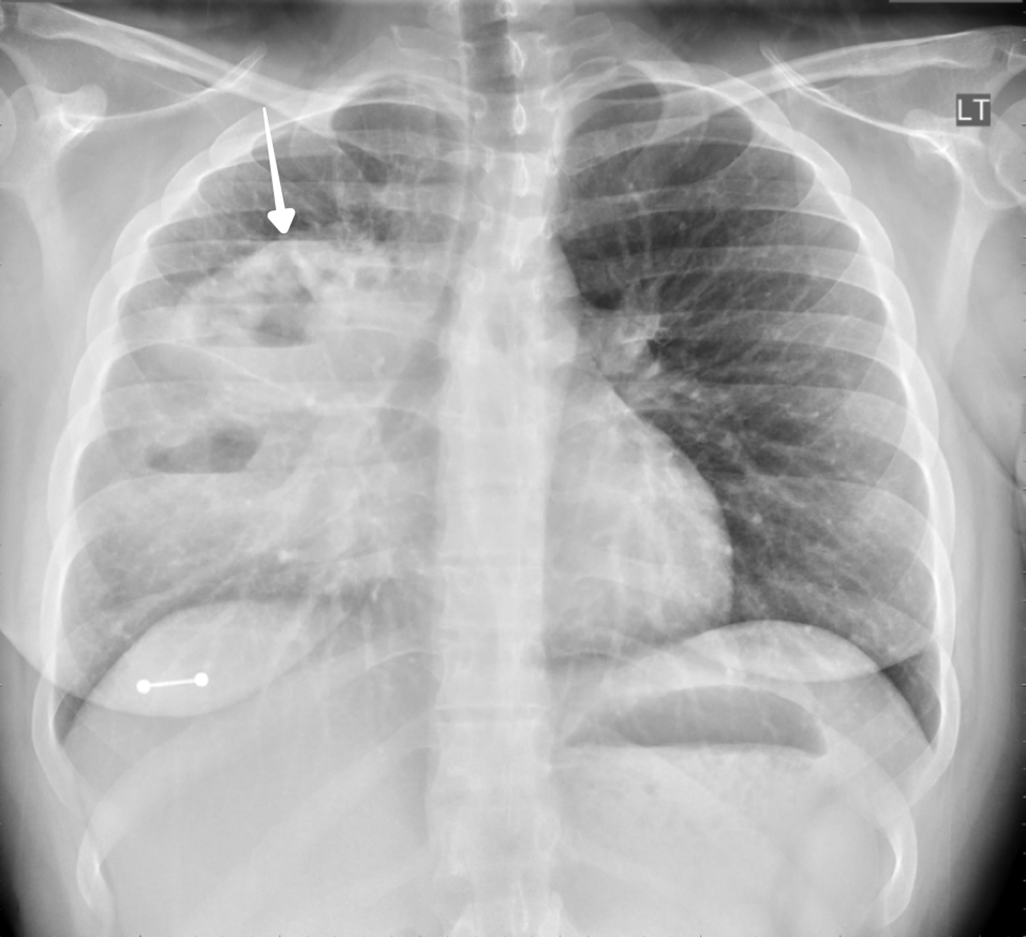 What Is A Cavitary Lung Mass