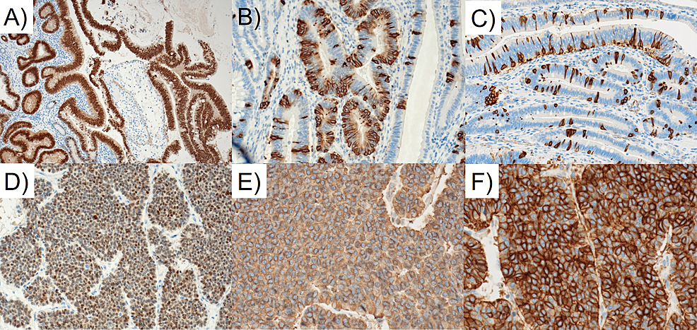 Cureus A Rare Collision Tumor Adenocarcinoma In The Ampulla Of Vater And Neuroendocrine Tumor