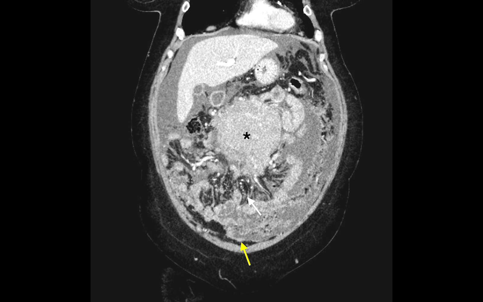 Bilateral Chylothorax And Chylous Ascites A Rare Presentation Of An