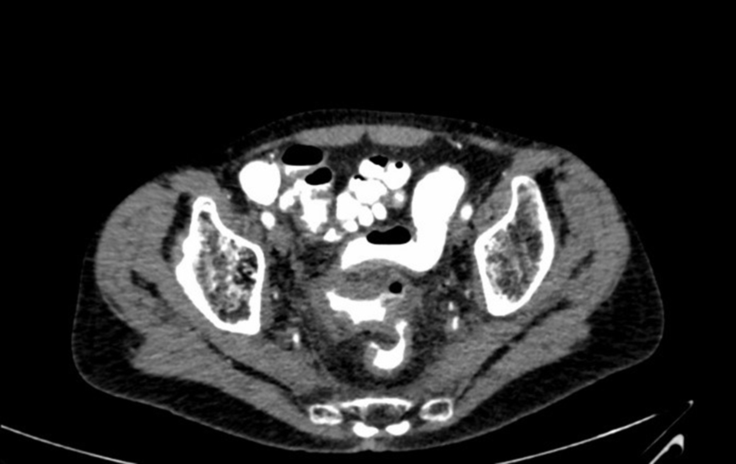 Cureus Acute Ischemic Gangrene Of The Rectosigmoid Colon In A Patient