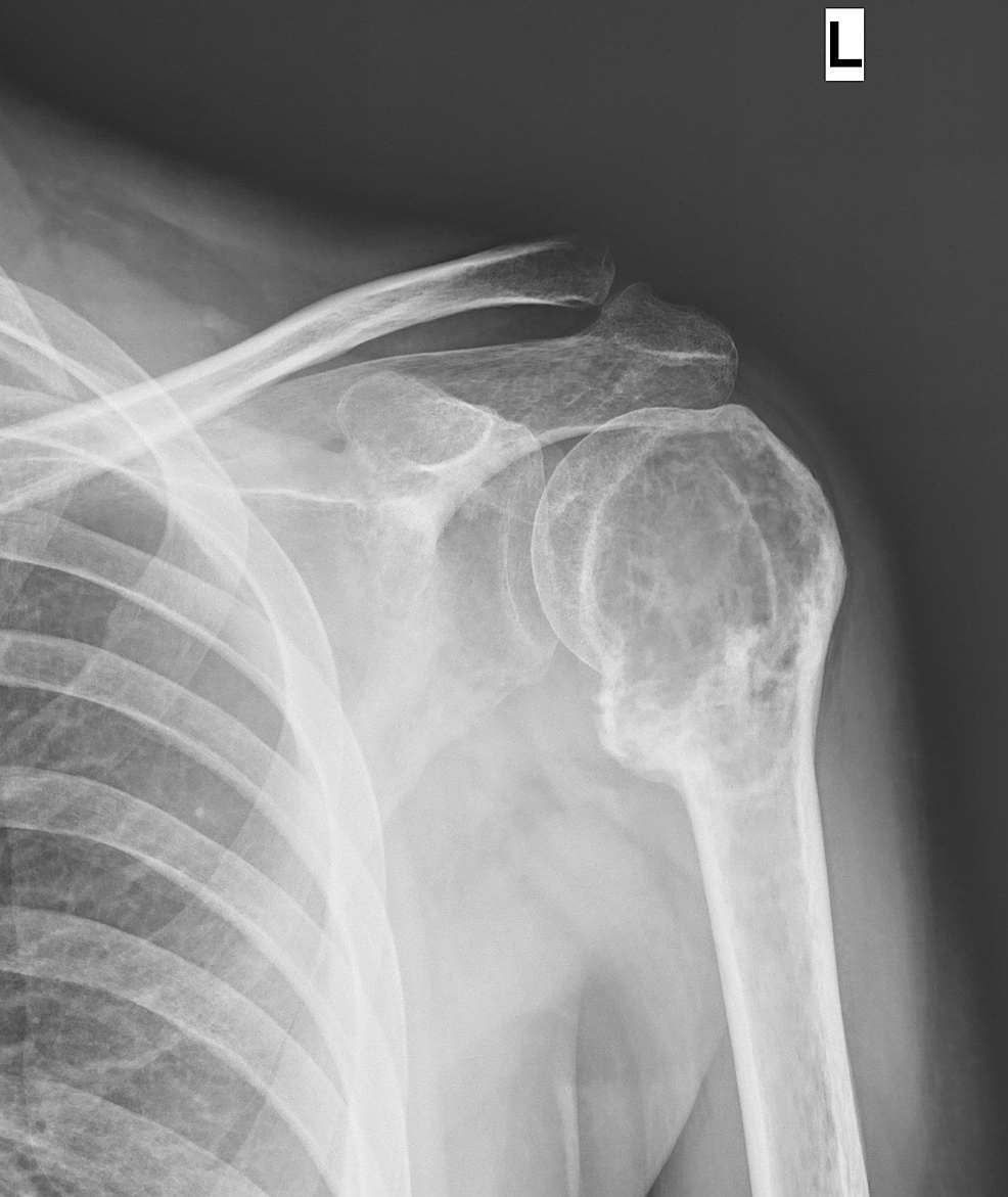 Cureus 'Salvage Treatment' of Aggressive Giant Cell Tumor of Bones with Denosumab