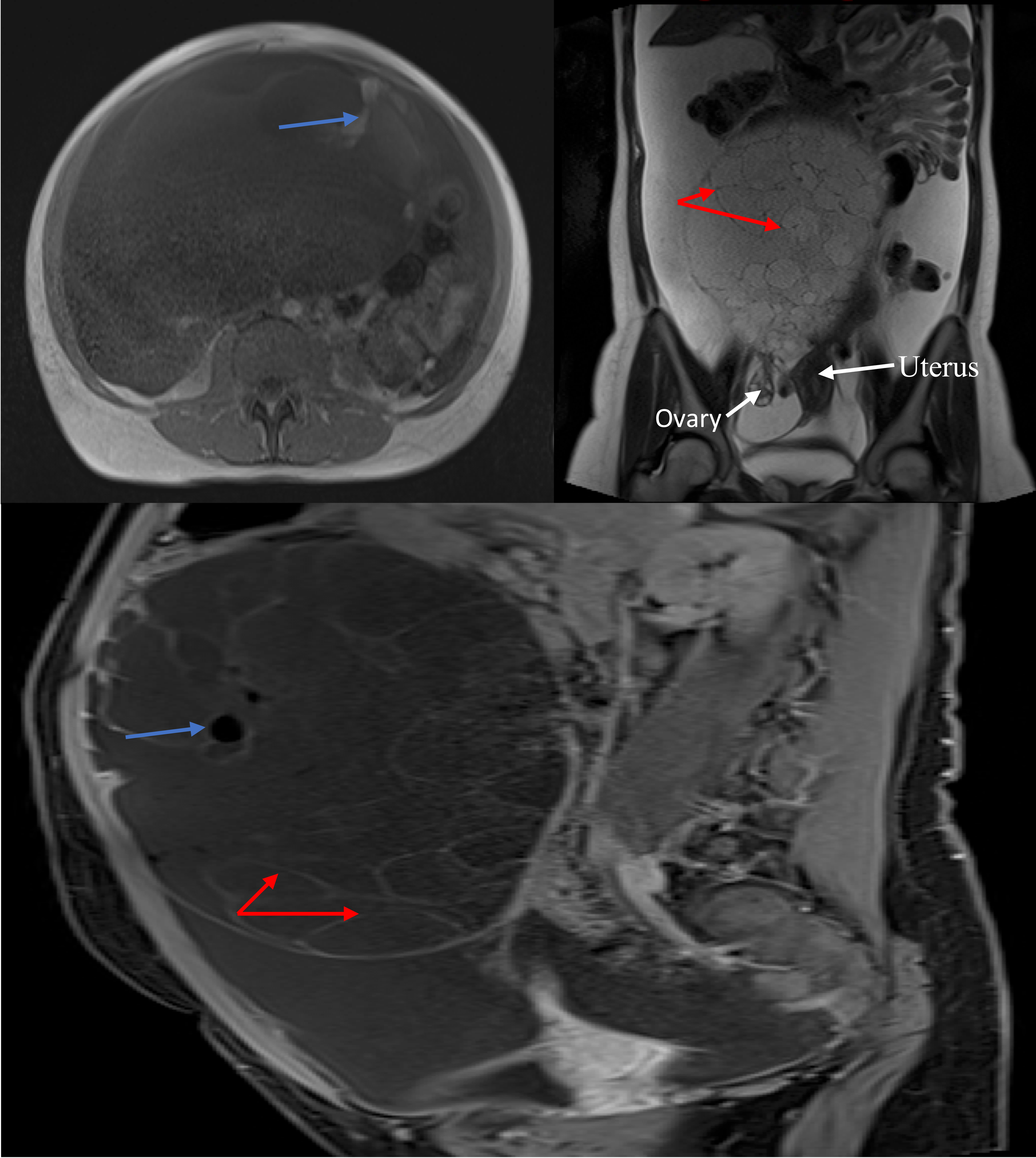 Cureus Ovarian Collision Tumor Massive Mucinous Cystadenoma And Benign Mature Cystic Teratoma