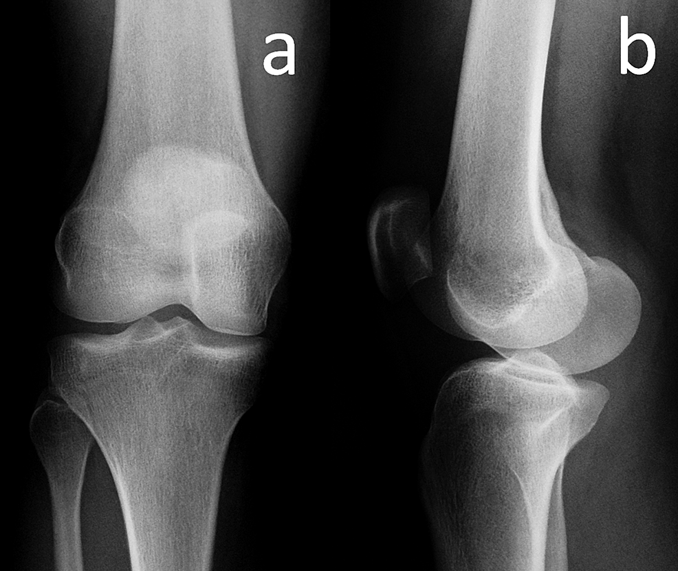 Anteroposterior-and-lateral-knee-radiographs-