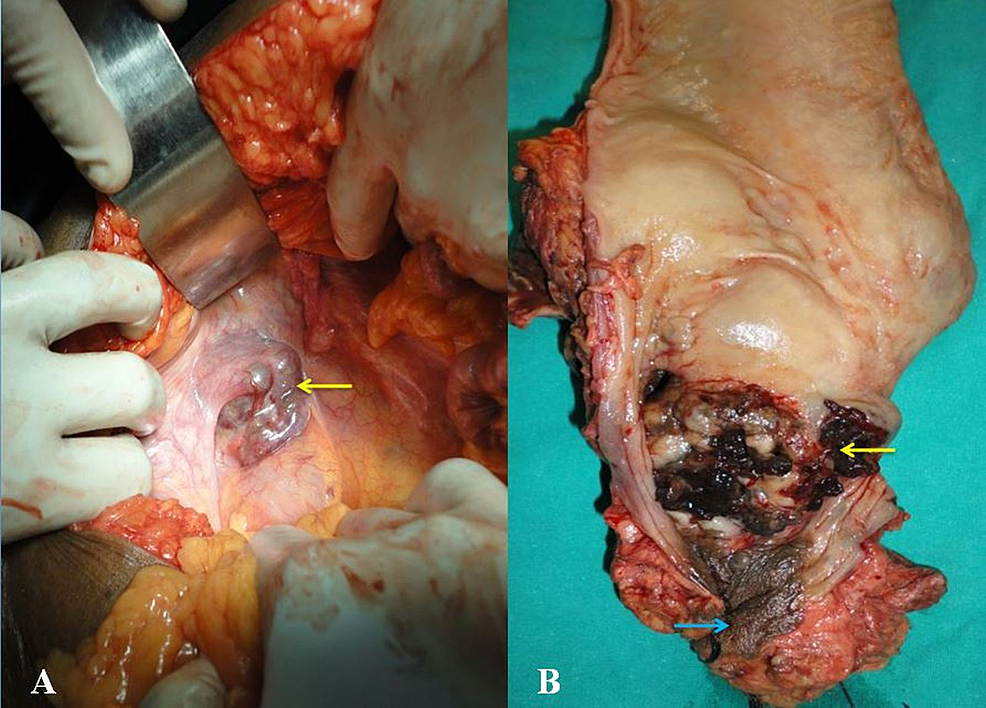 Cureus A Rare Case Of Primary Anorectal Malignant Melanoma