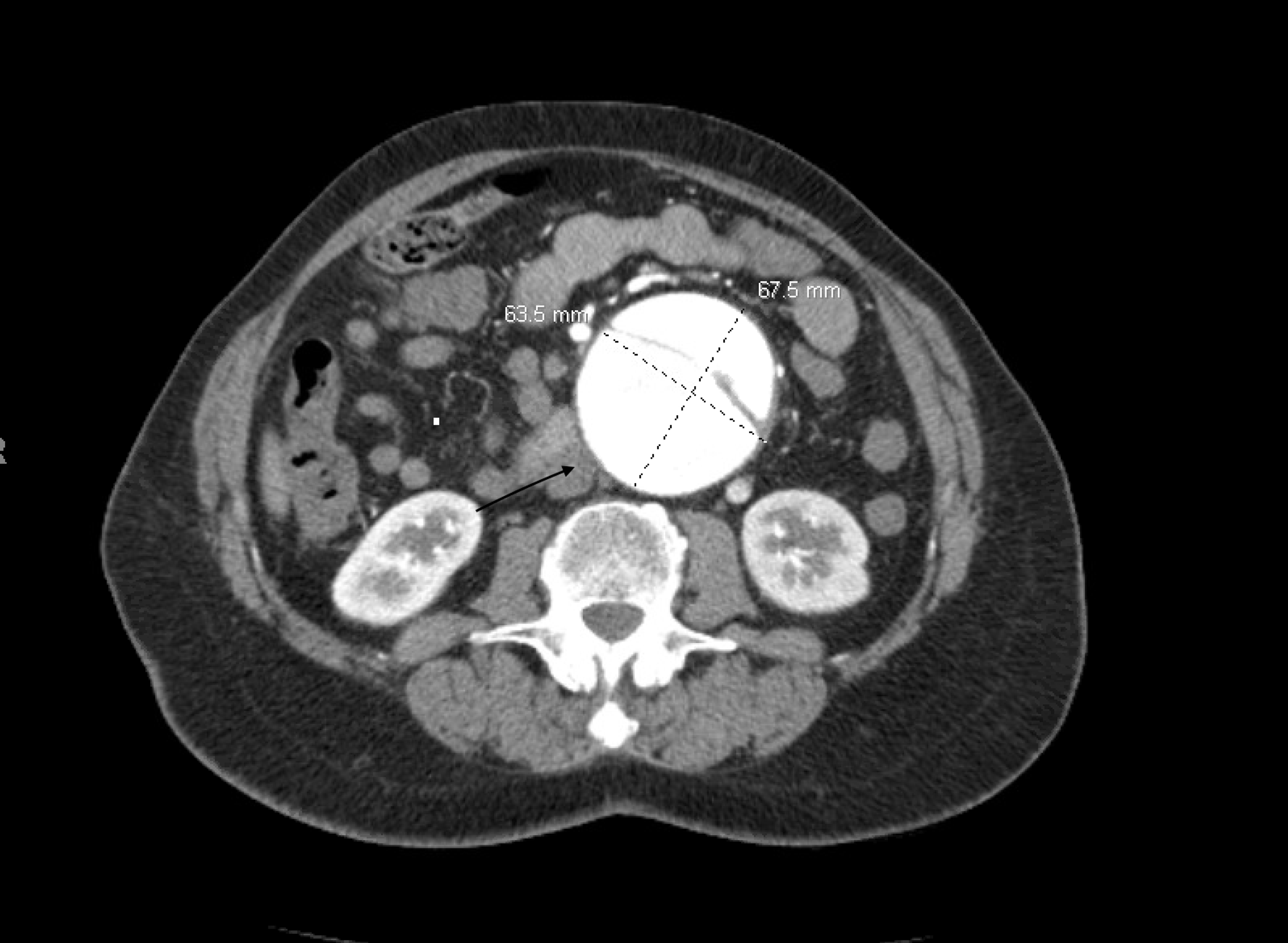 Cureus Identification And Management Of Abdominal Aortic Dissection