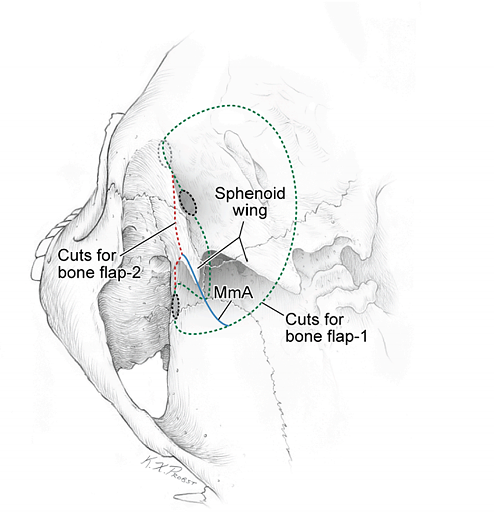 Cureus TwoPart Pterional Craniotomy