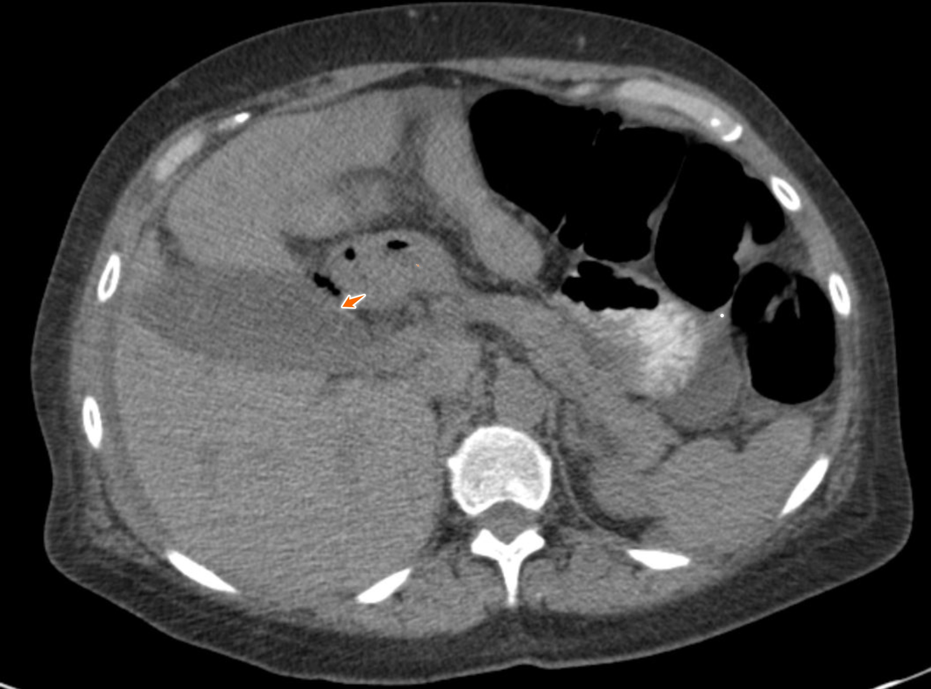 Cureus Necrotizing Cholecystitis In The Gallbladder A Case Report