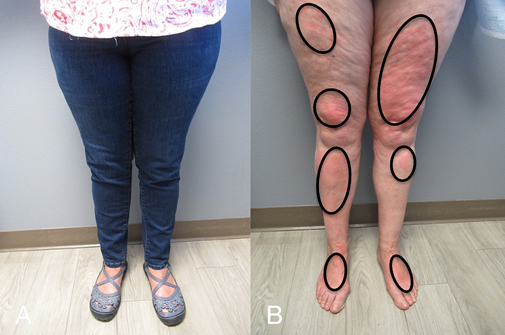 Cureus A Woman With Solar Urticaria And Heat Urticaria A Unique