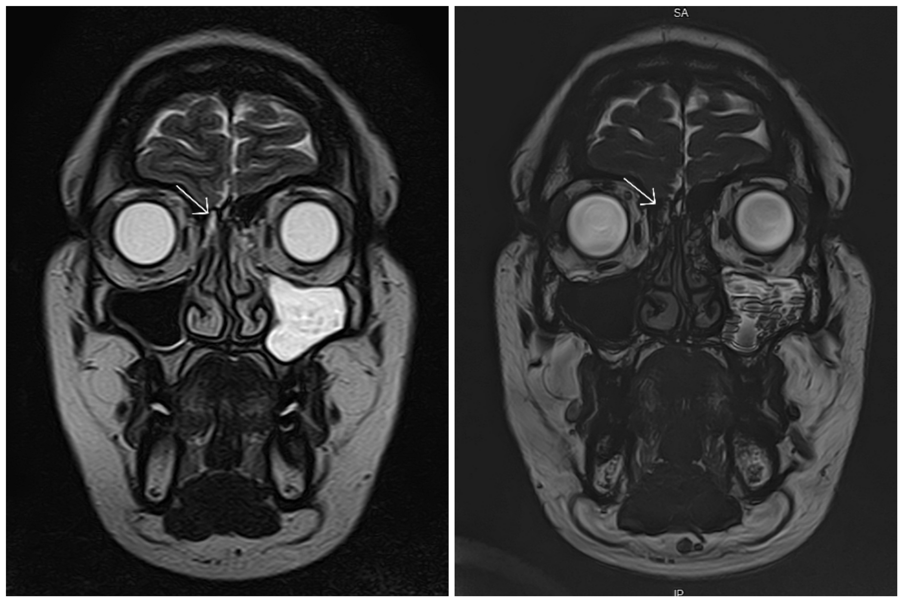 Cureus Zipline Into A Case Of Spontaneous Cerebrospinal Fluid Rhinorrhea